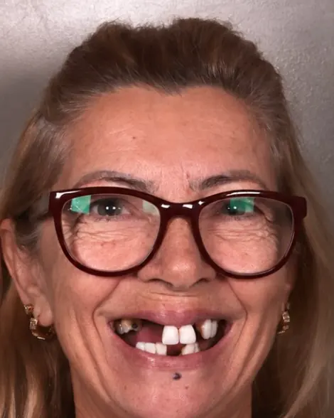 Transformação do sorriso: antes