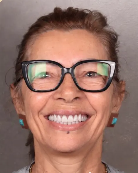Transformação do sorriso: depois