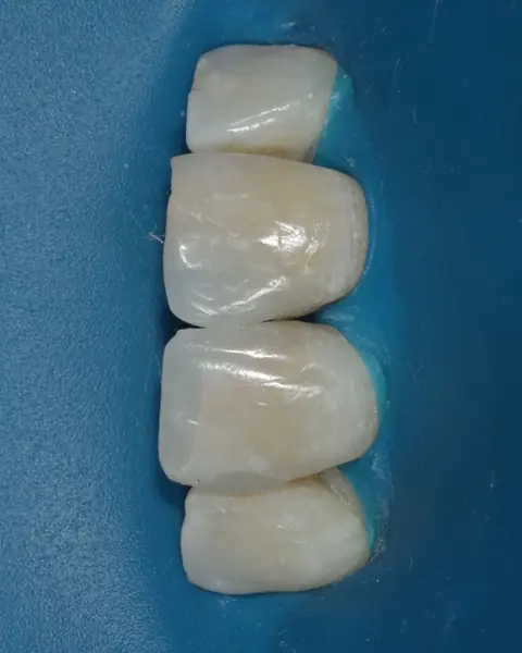 Dentes anteriores em resina com isolamento