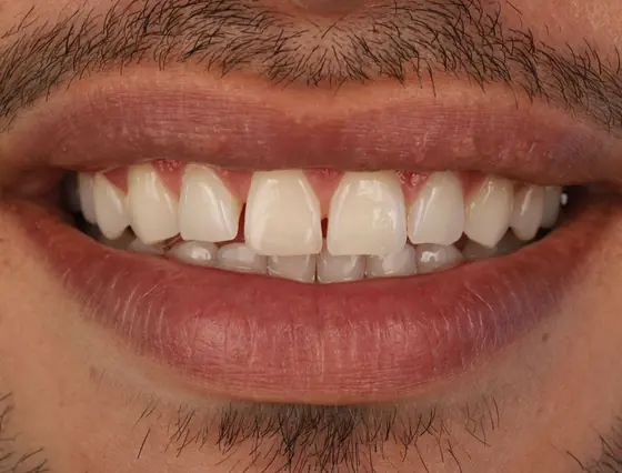 Sorriso natural após tratamento estético