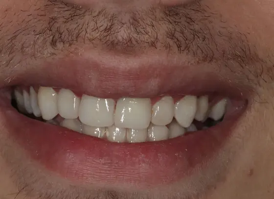 Sorriso amplo com dentes claros e naturais