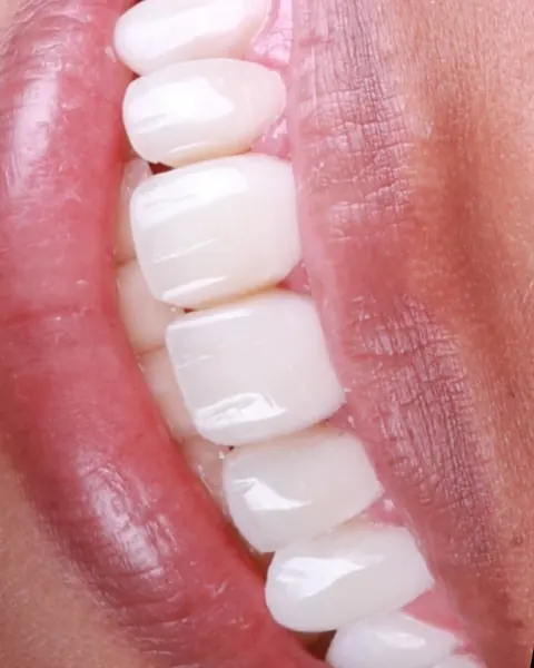 Sorriso com facetas em resina, visto de lado