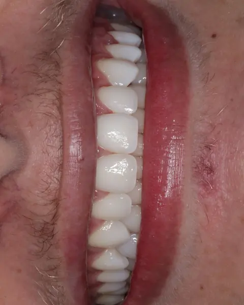 Perfil de sorriso com dentes alinhados